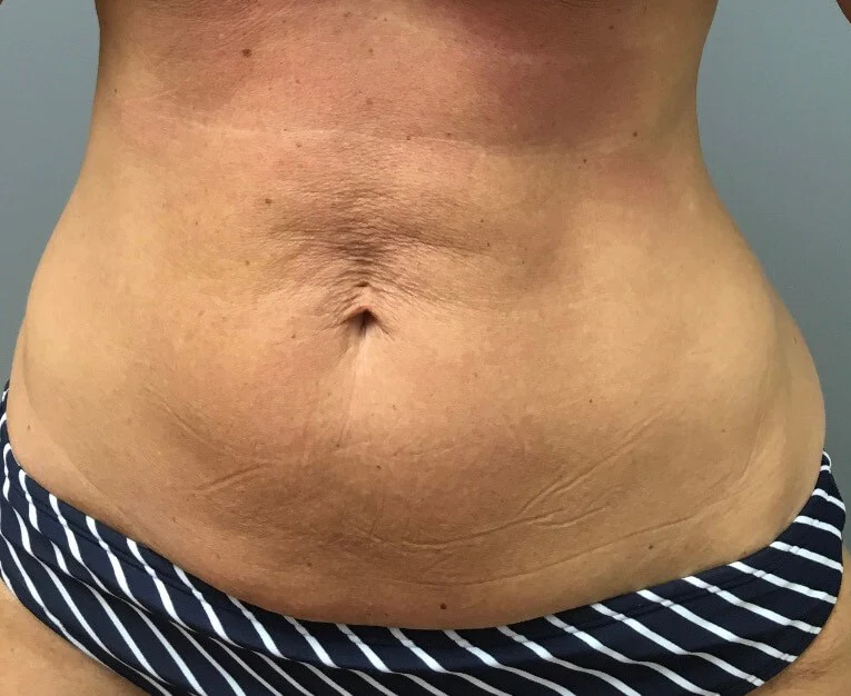 body-contouring-