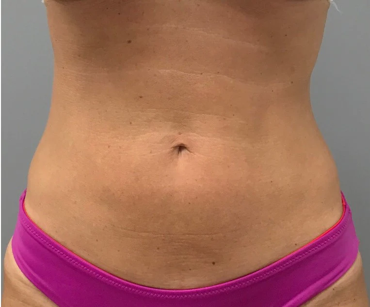 body-contouring-after
