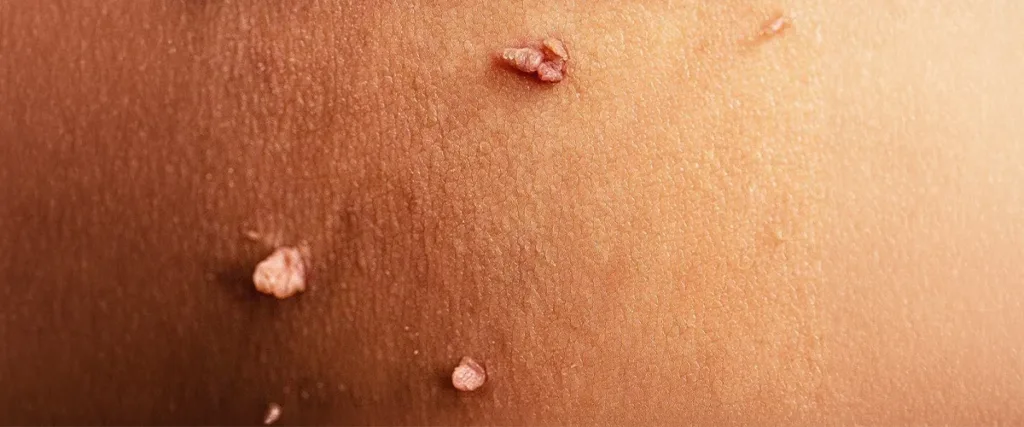 Does Treating Genital Warts Reduce HPV Transmission