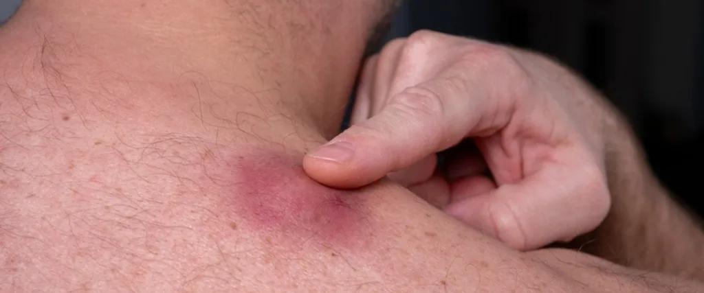 When Should a Cyst Be Removed